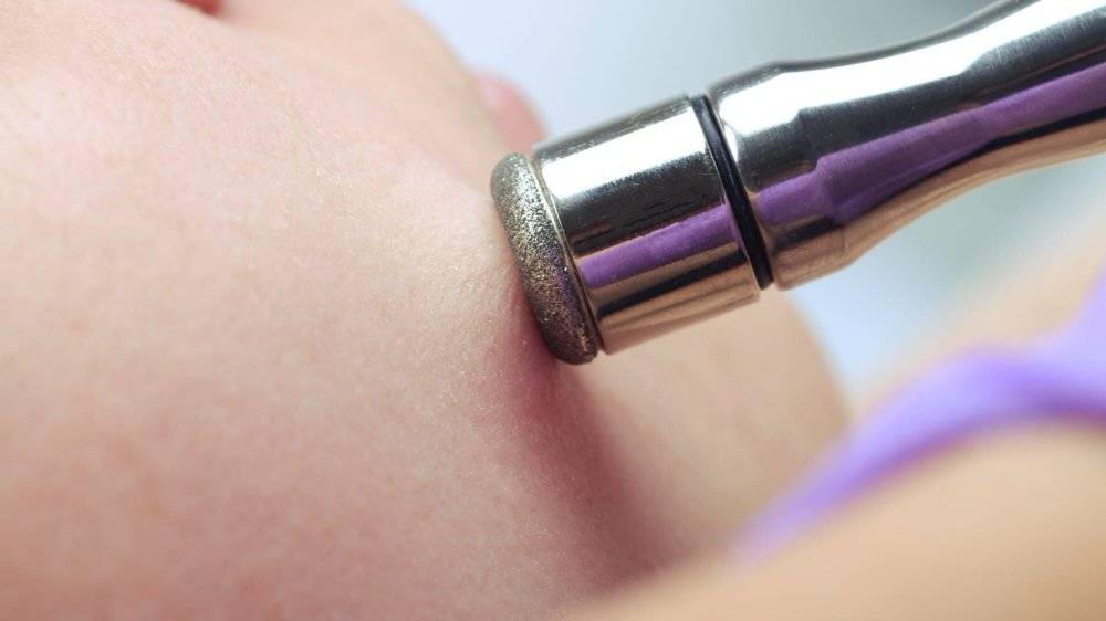 Microdermabrasion Treatment