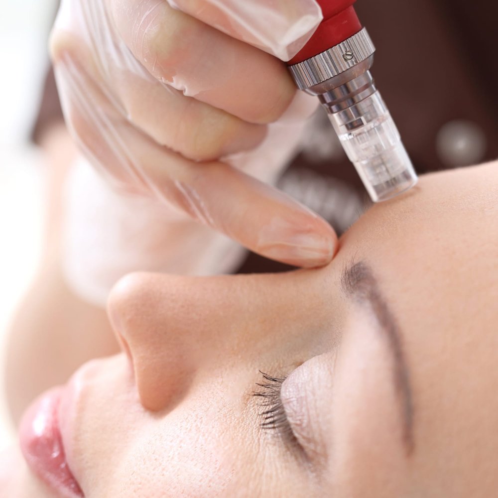 Microneedling Acne Scar Reduction
